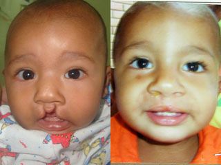 Cleft Lip and Palate Surgery Before and After Photo